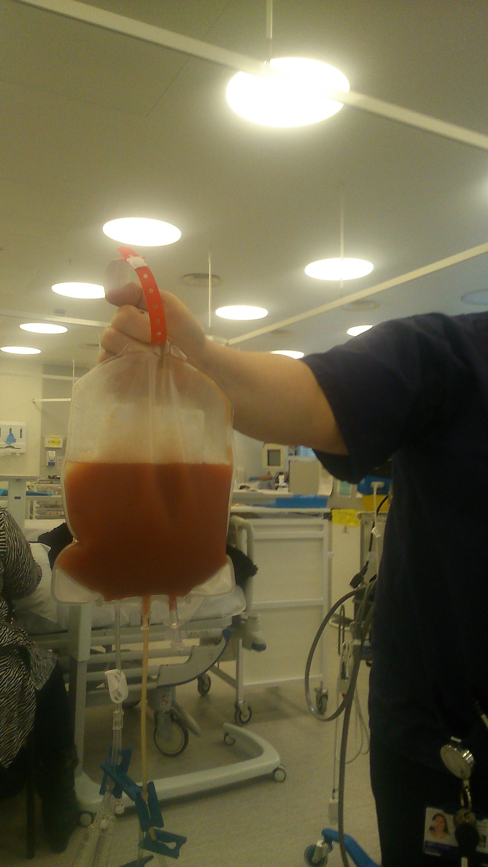 Bag containing Tim's stem cells for George's transplant
